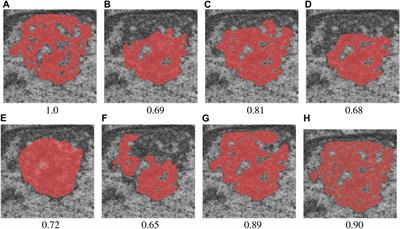 Efficient semi-supervised semantic segmentation of electron microscopy cancer images with sparse annotations